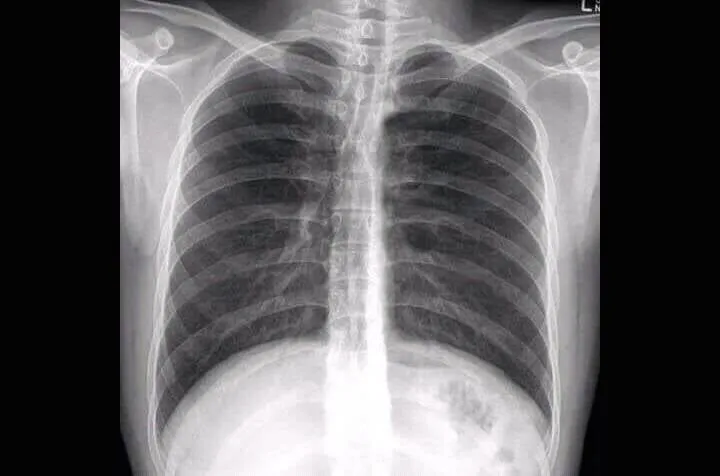 MinXray HF100H 