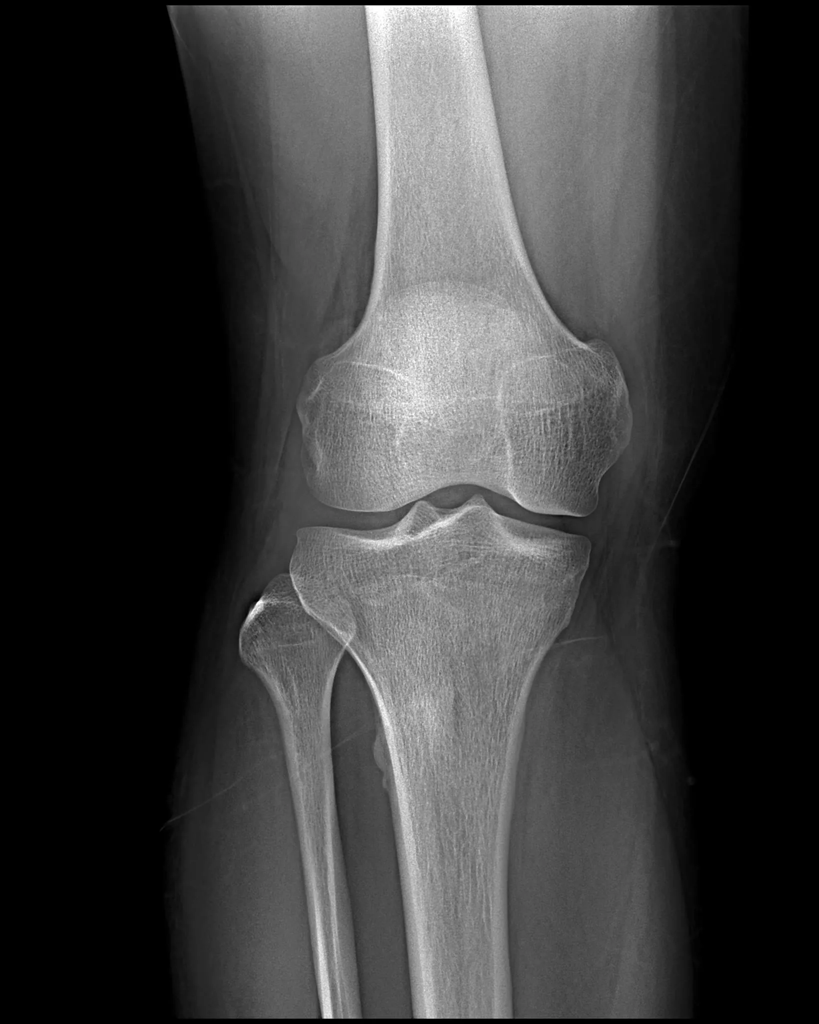 MinXray HF100H 